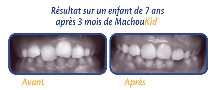 MachouKid Gouttière Dentaire +6 ans